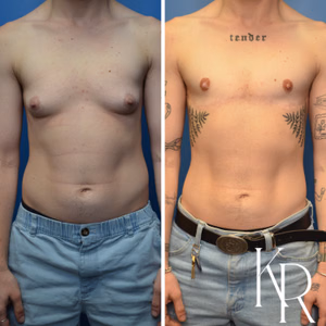 Top surgery before and after photo, front view