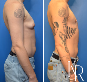 Top surgery before and after photo, side view