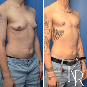 Top surgery before and after photo, front view