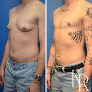 Top surgery before and after photo, side view