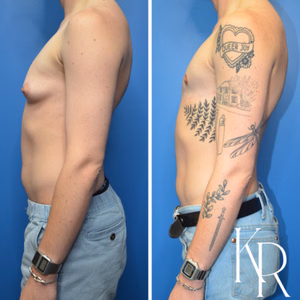 Top surgery before and after photo, front view