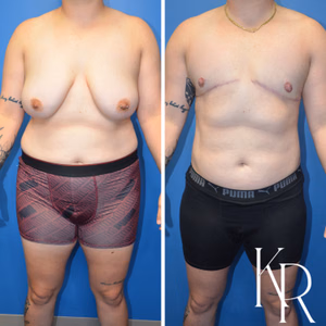 Top surgery before and after photo, front view