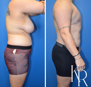 Top surgery before and after photo, side view