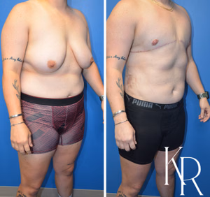Top surgery before and after photo, front view
