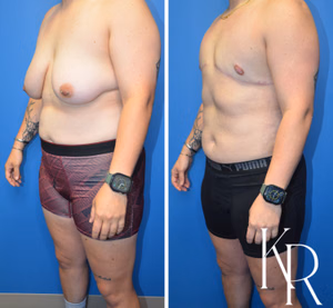Top surgery before and after photo, side view