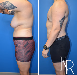 Top surgery before and after photo, front view