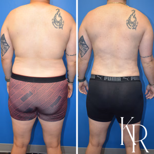 Top surgery before and after photo, front view