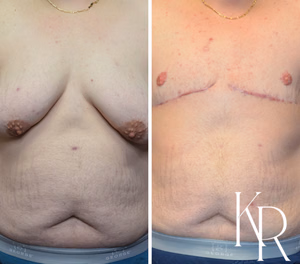 Top surgery before and after photo, side view