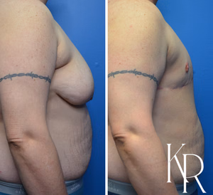 Top surgery before and after photo, front view
