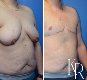 Top surgery before and after photo, side view