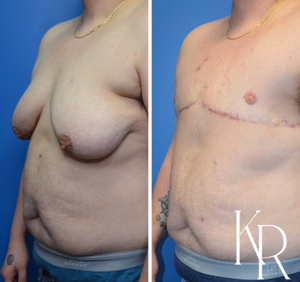 Top surgery before and after photo, side view