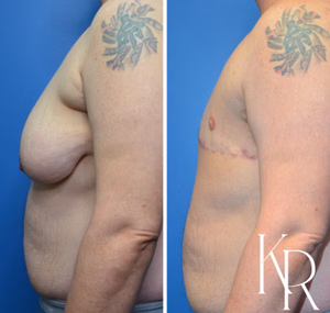 Top surgery before and after photo, front view