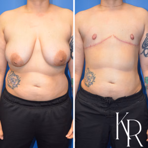 Top surgery before and after photo, side view