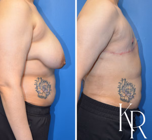 Top surgery before and after photo, front view