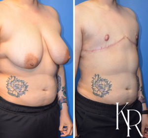 Top surgery before and after photo, side view