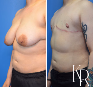 Top surgery before and after photo, front view
