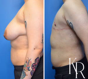 Top surgery before and after photo, side view