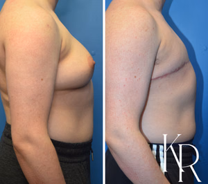 Top surgery before and after photo, side view