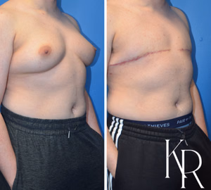 Top surgery before and after photo, side view