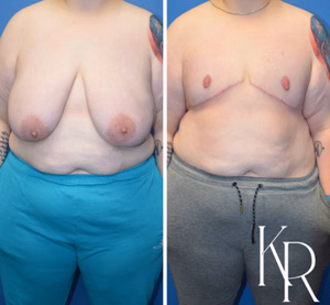 Top surgery before and after photo, side view