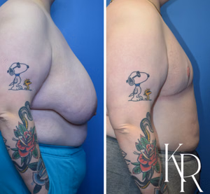 Top surgery before and after photo, side view