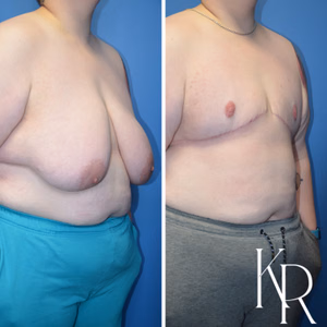 Top surgery before and after photo, oblique view