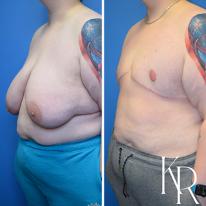 Top surgery before and after photo, oblique view