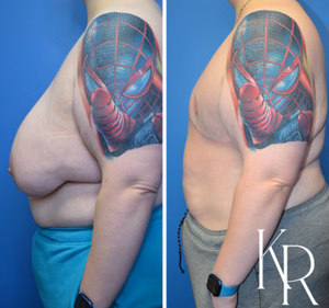Top surgery before and after photo, side view