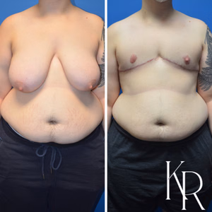 Top surgery before and after photo, front view