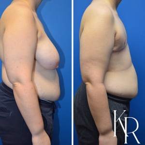 Top surgery before and after photo, side view