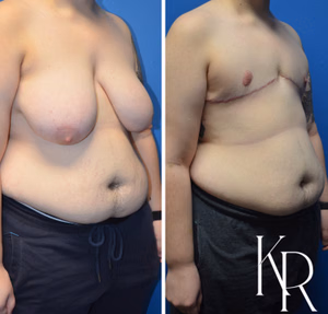 Top surgery before and after photo, oblique view