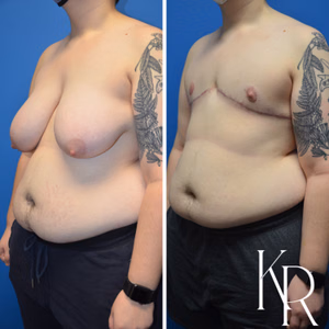 Top surgery before and after photo, oblique view