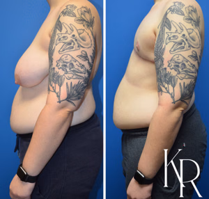 Top surgery before and after photo, side view