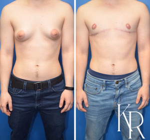 Top surgery before and after photo, front view