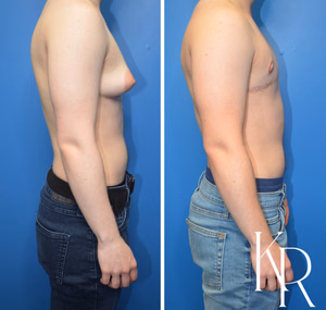Top surgery before and after photo, side view