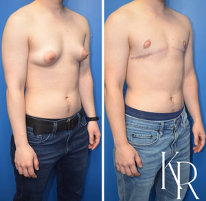 Top surgery before and after photo, oblique view