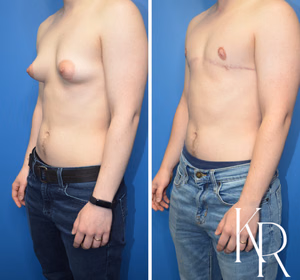 Top surgery before and after photo, oblique view