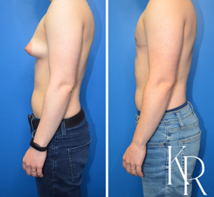 Top surgery before and after photo, side view