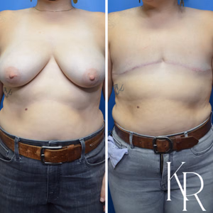 Top surgery before and after photo, front view