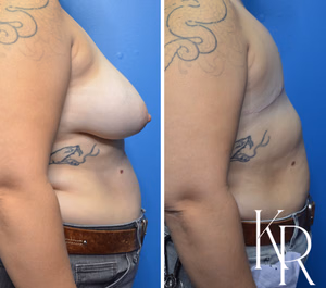 Top surgery before and after photo, side view