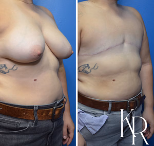 Top surgery before and after photo, oblique view