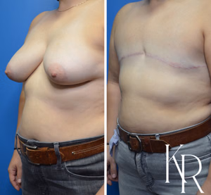 Top surgery before and after photo, oblique view