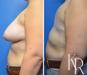 Top surgery before and after photo, side view