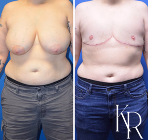 Top surgery before and after photo, front view