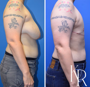Top surgery before and after photo, side view