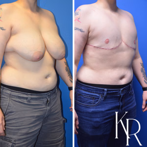 Top surgery before and after photo, front view