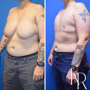 Top surgery before and after photo, side view