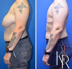 Top surgery before and after photo, front view