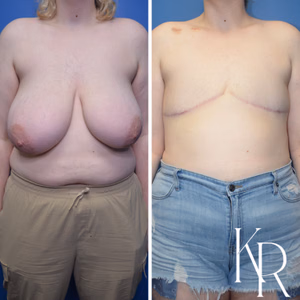 Top surgery before and after photo, side view