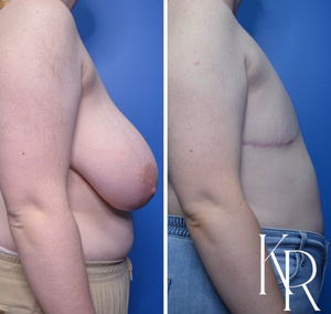 Top surgery before and after photo, side view
